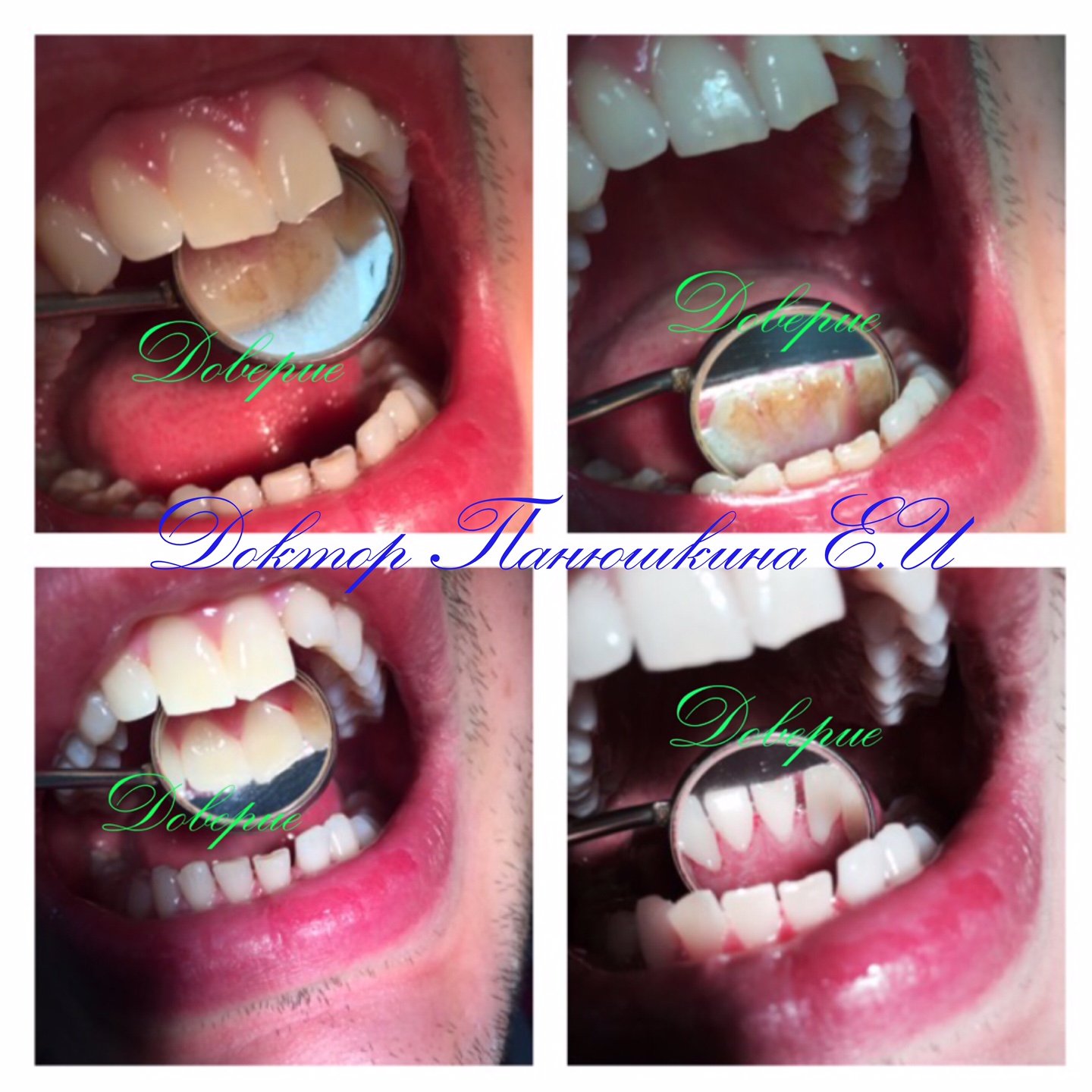 Комплексная чистка зубов&nbsp;Современная стоматология "ДОВЕРИЕ" : 