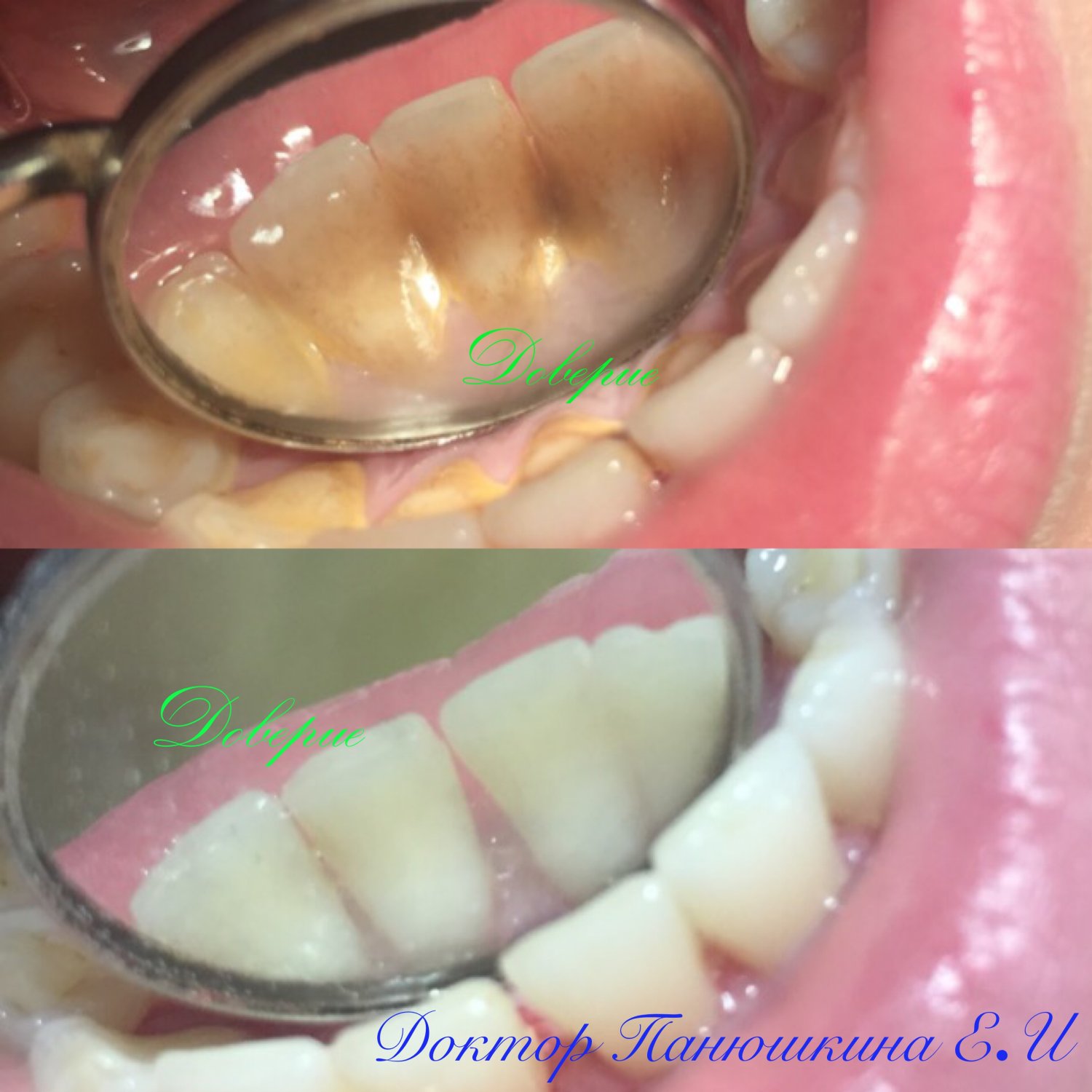 Комплексная чистка зубов&nbsp;Современная стоматология "ДОВЕРИЕ" : 