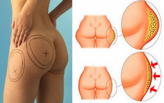 Коррекция фигуры. Обертывание&nbsp;Карамельные ножки, спа-кабинет : 